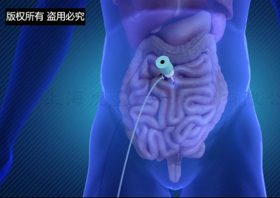 直肠癌手术动画.png