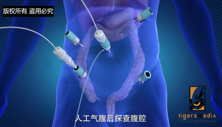 肠镜-1.jpg